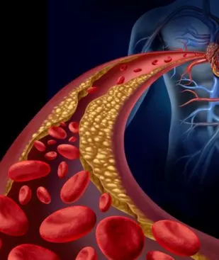 Cholesterol Treatment