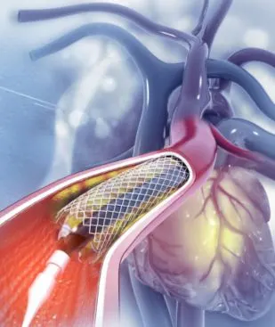 Interventional Cardiology